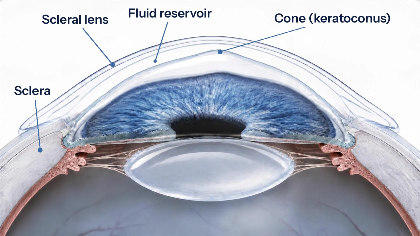 Cross-section of the front of the eye with a scleral contact lens resting on the sclera and vaulting over the cornea, with a thin layer of fluid between the lens and the cornea