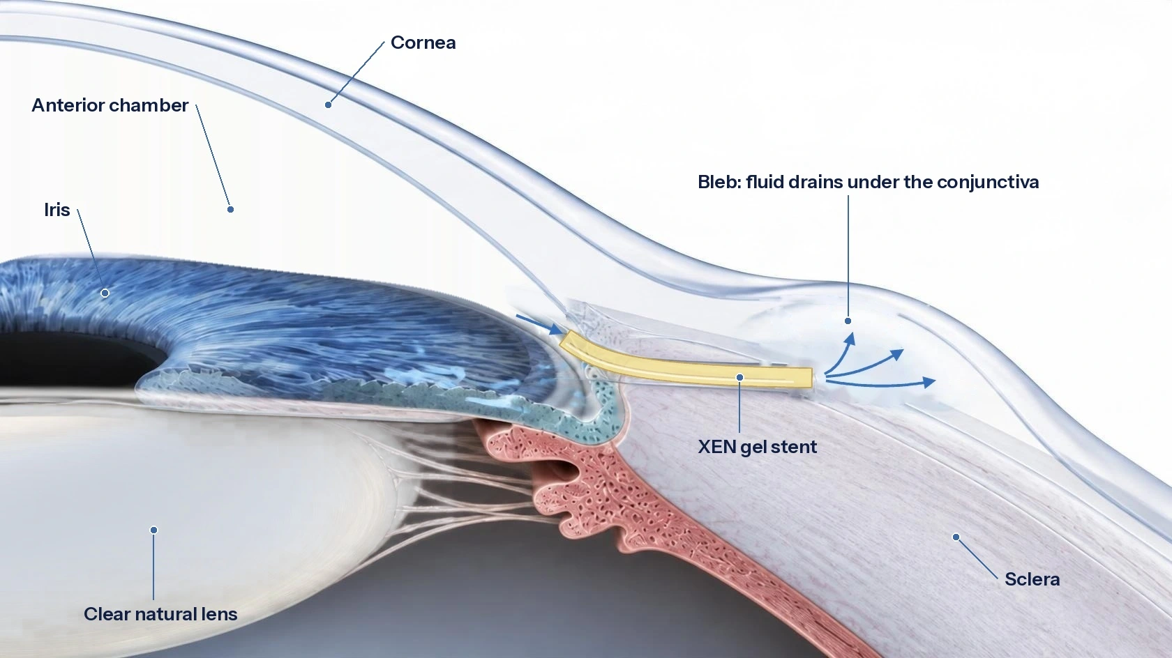 Cross-section of the front of the eye showing a small yellow XEN gel stent running from the anterior chamber through the drainage angle to a fluid pocket under the conjunctiva, with arrows showing fluid flow